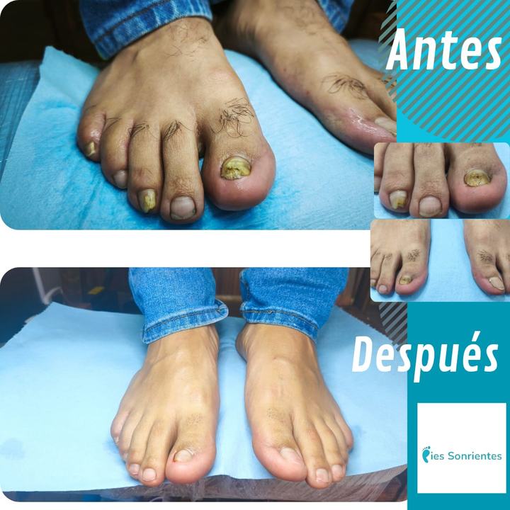Antes y después de un tratamiento de onicomicosis