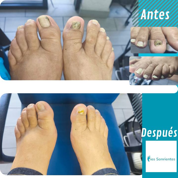 Antes y después de un tratamiento de uñas