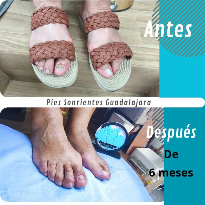 Antes y después de seis meses de tratamiento