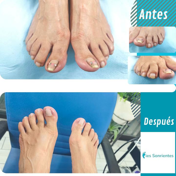 Antes y después de un tratamiento podológico