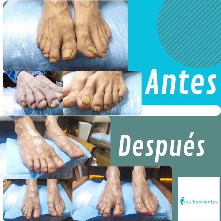 Antes y después de un tratamiento de onicomicosis